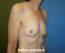 plastic-surgery-breast-augmentation
